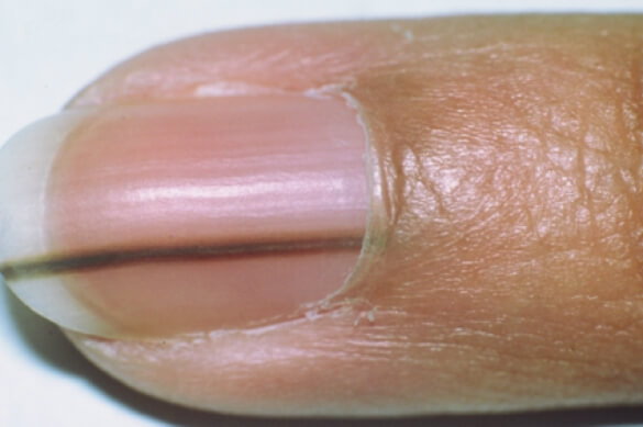 Naevus de l’ongle