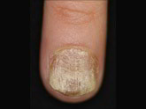 pelade-ongle
