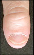 psoriasis articulaire