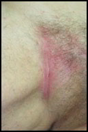 psoriasis des plis