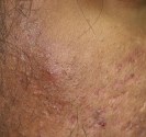 Hirsutisme