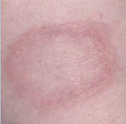 Granulome annulaire